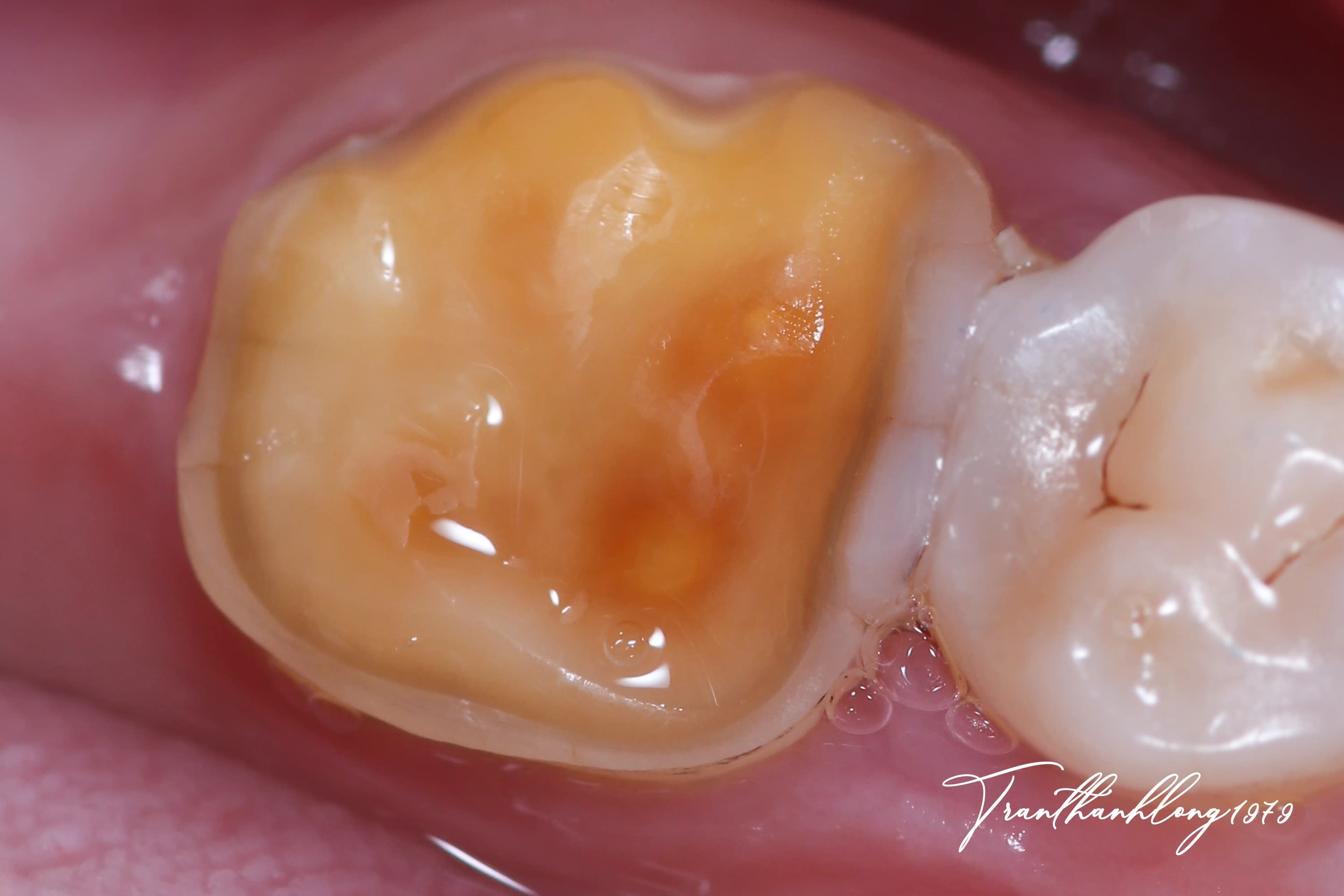 Kết quả điều trị của 001220723 - Before