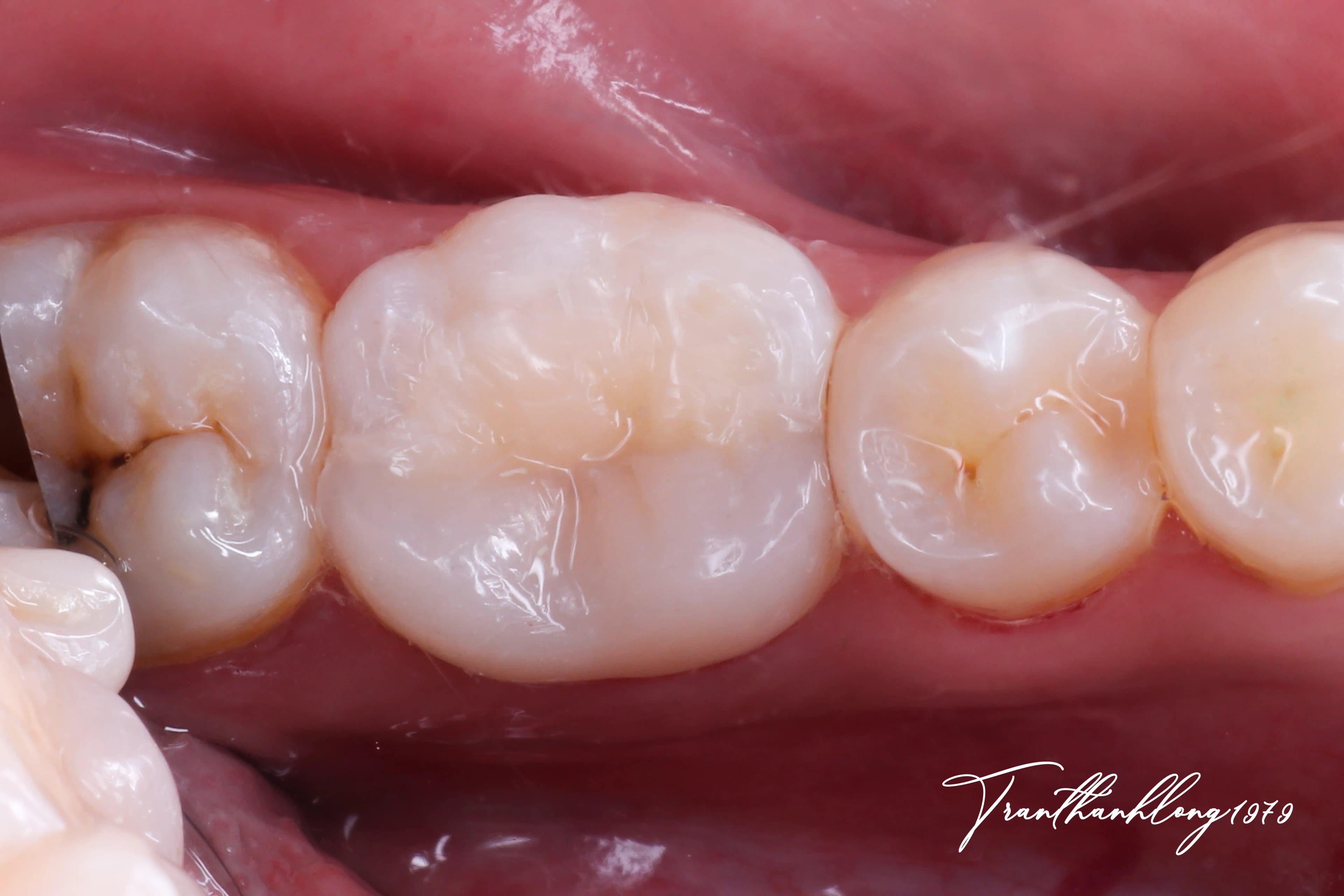 Kết quả điều trị của 004060825 - After