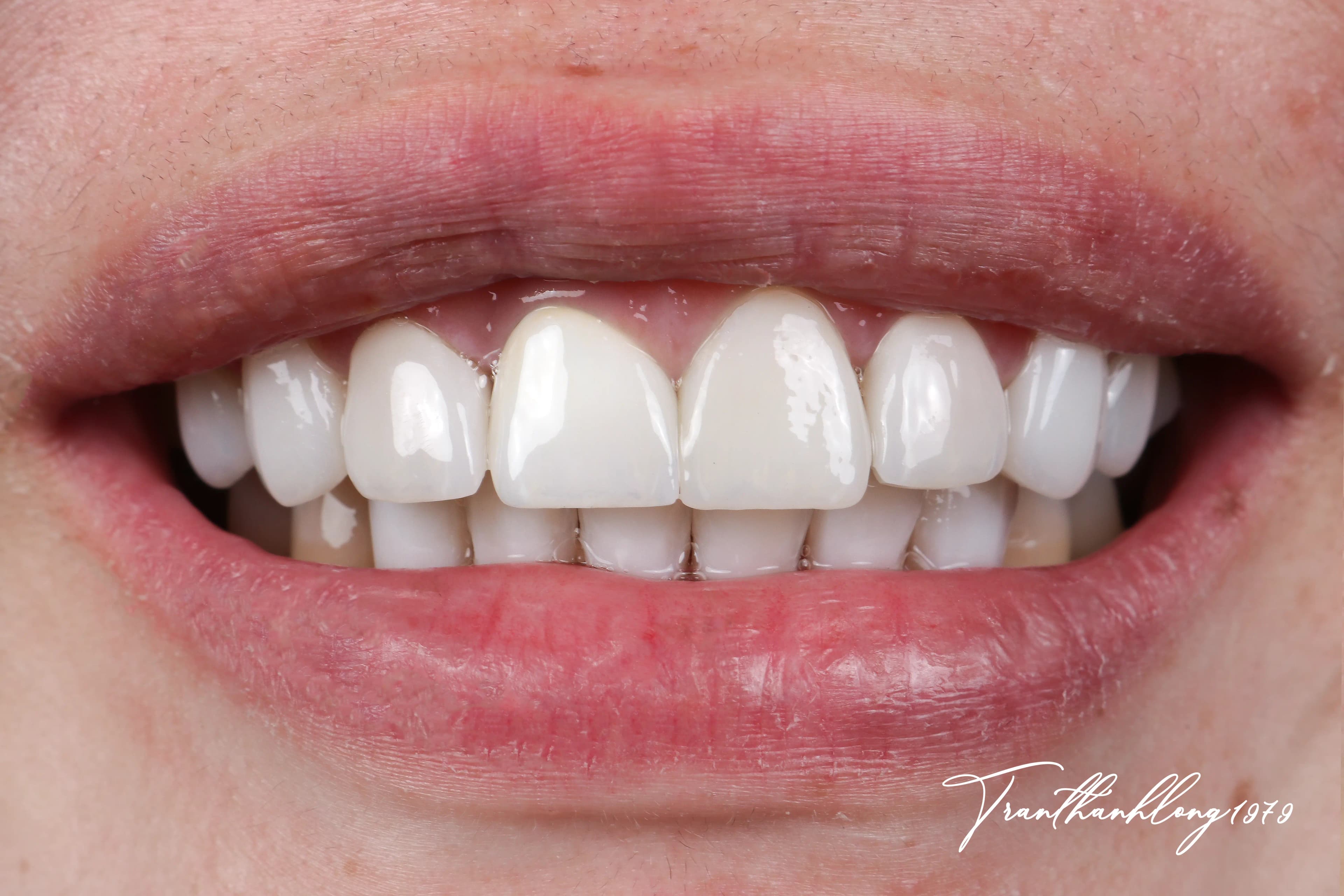 Kết quả điều trị của 003211125 - After