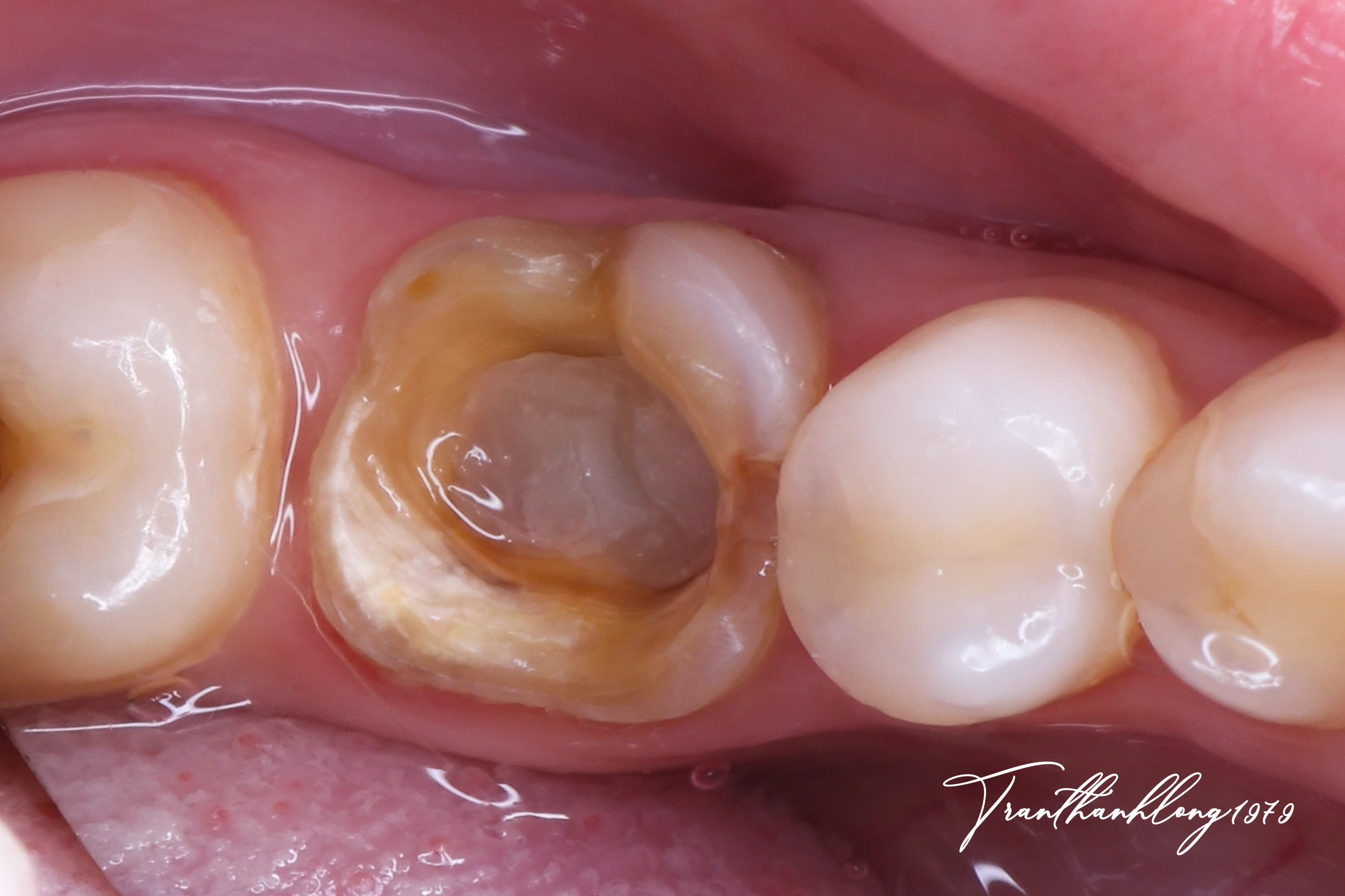 Kết quả điều trị của 005090123 - Before