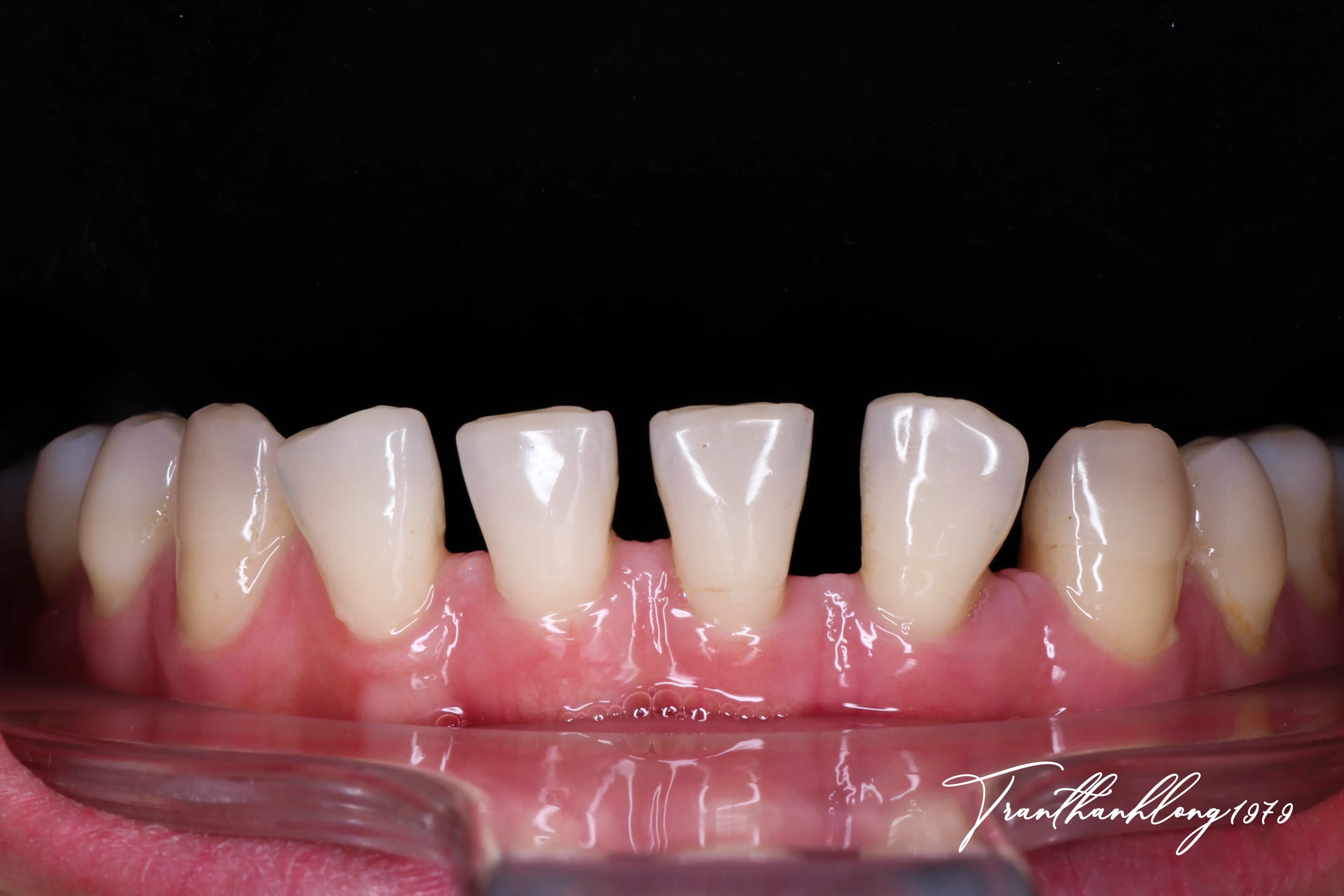 Kết quả điều trị của 002121224 - Before