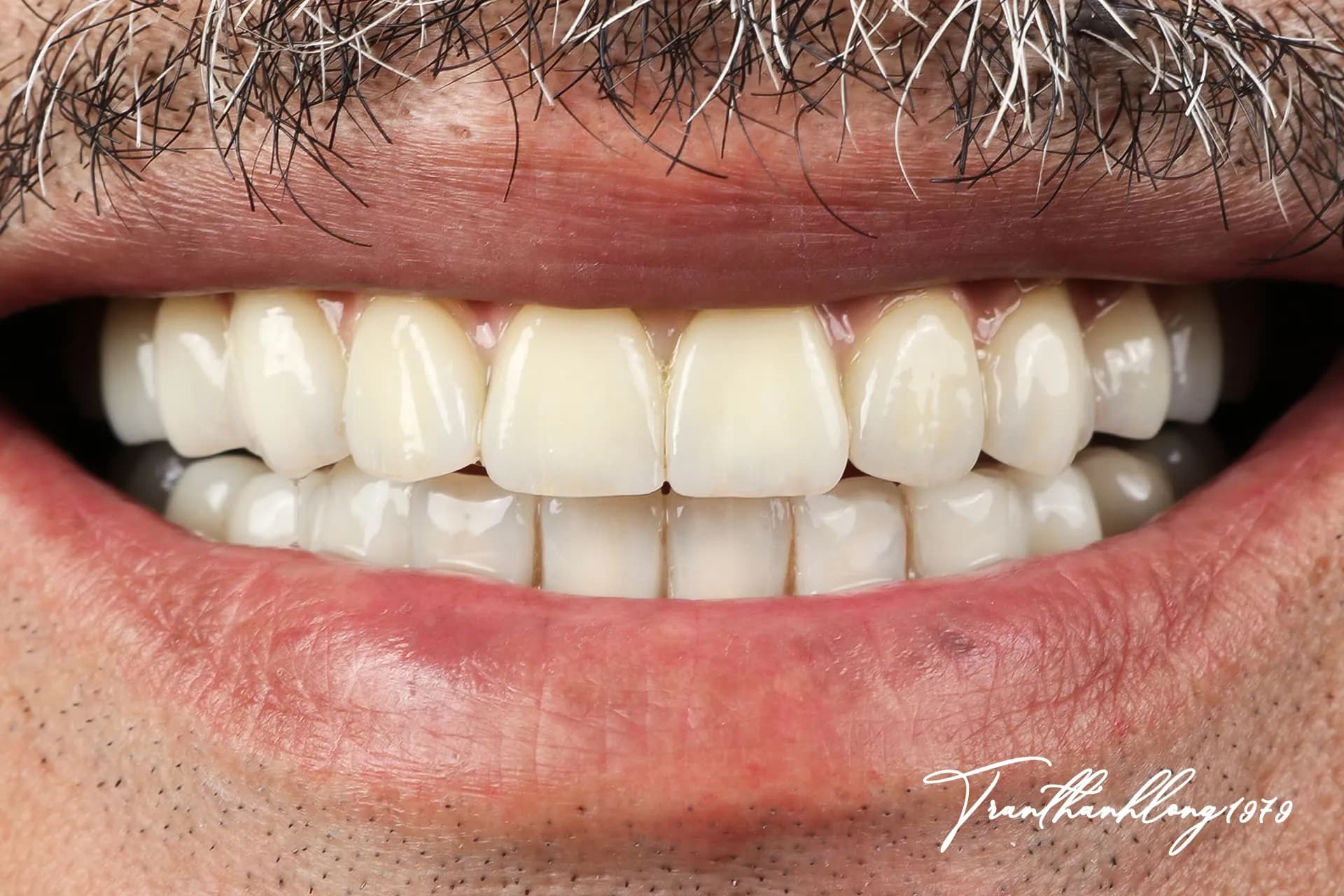 Kết quả điều trị của  007030923 - After