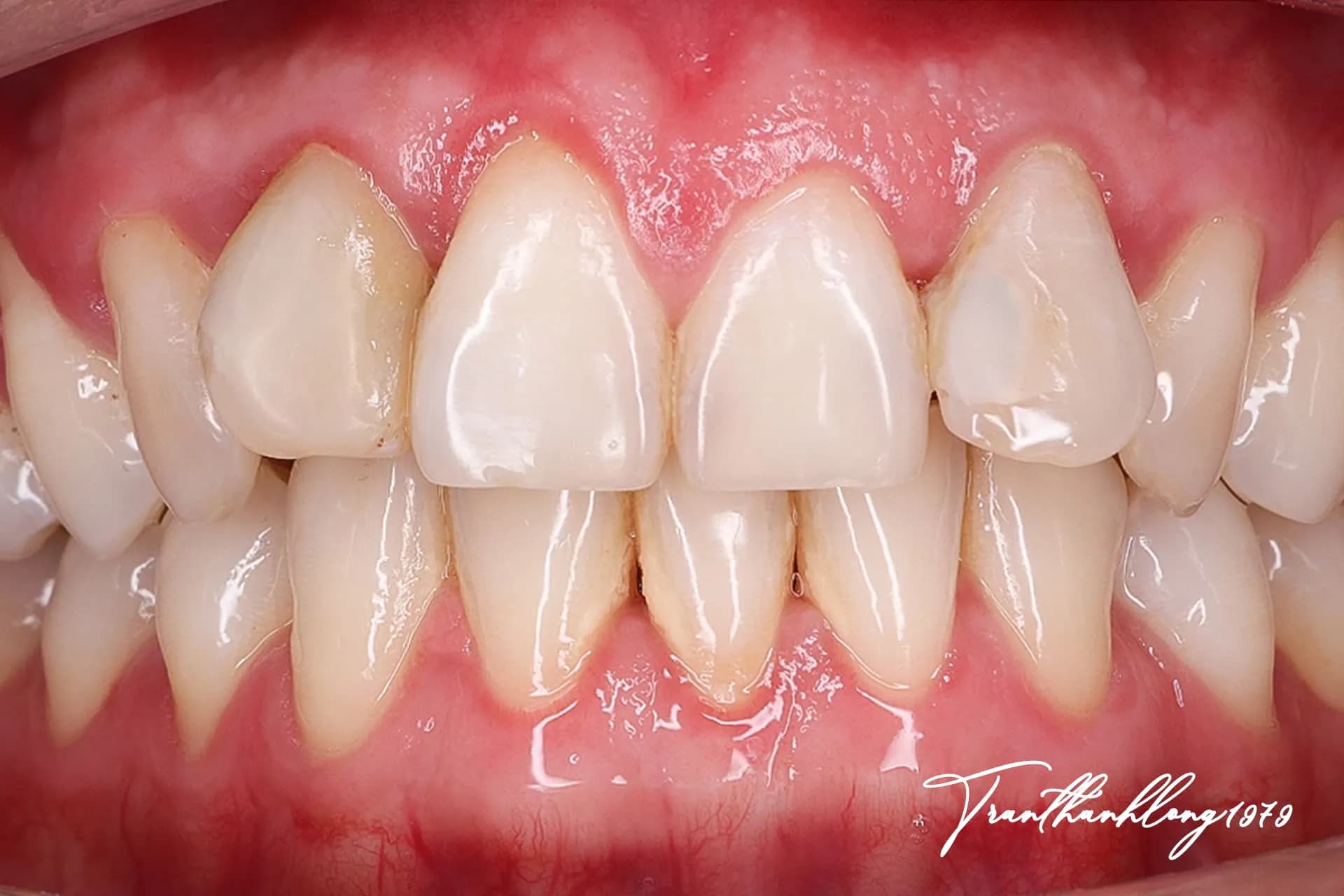 Kết quả điều trị của 006300622 - Before