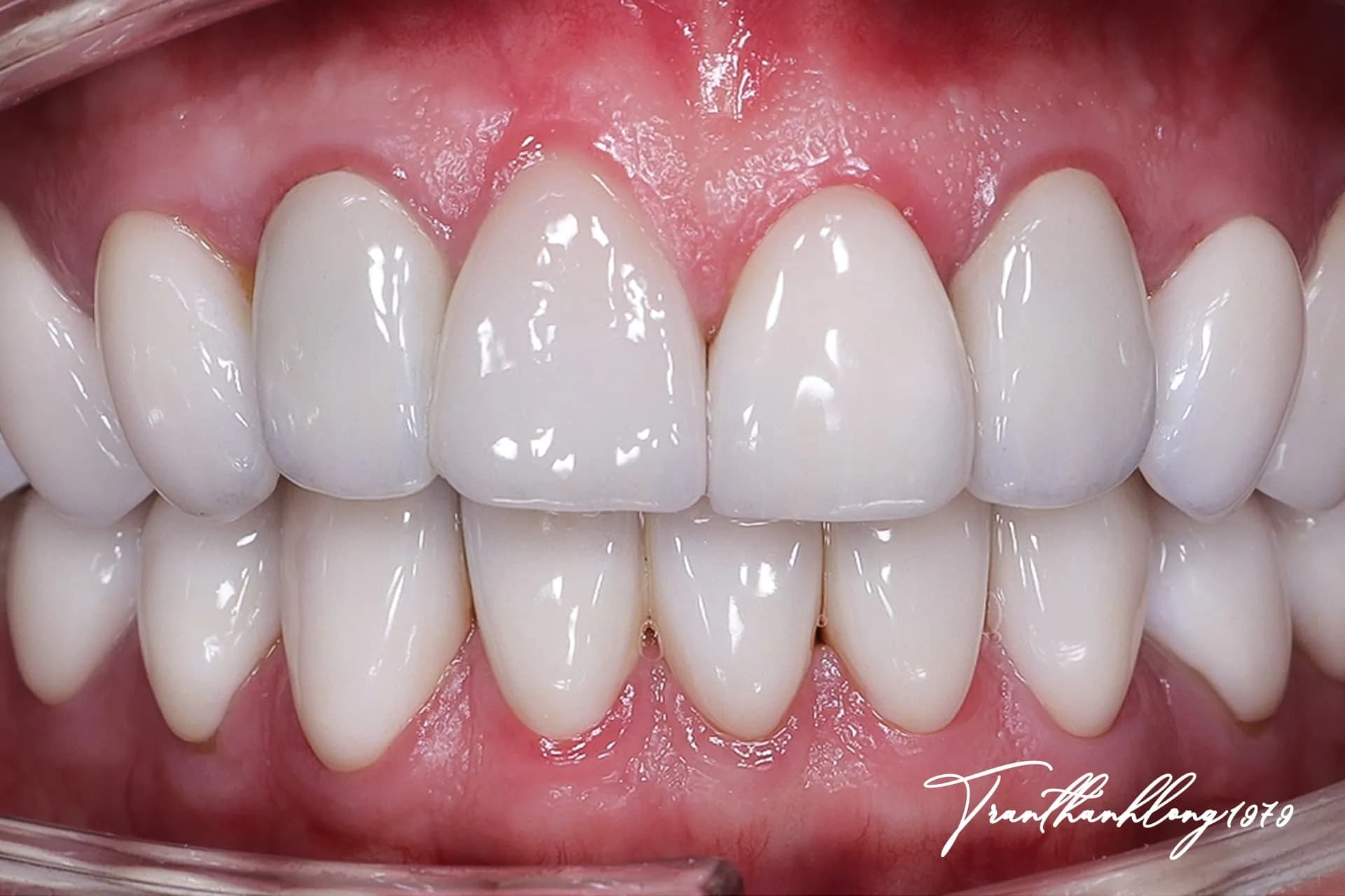 Kết quả điều trị của 006300622 - After