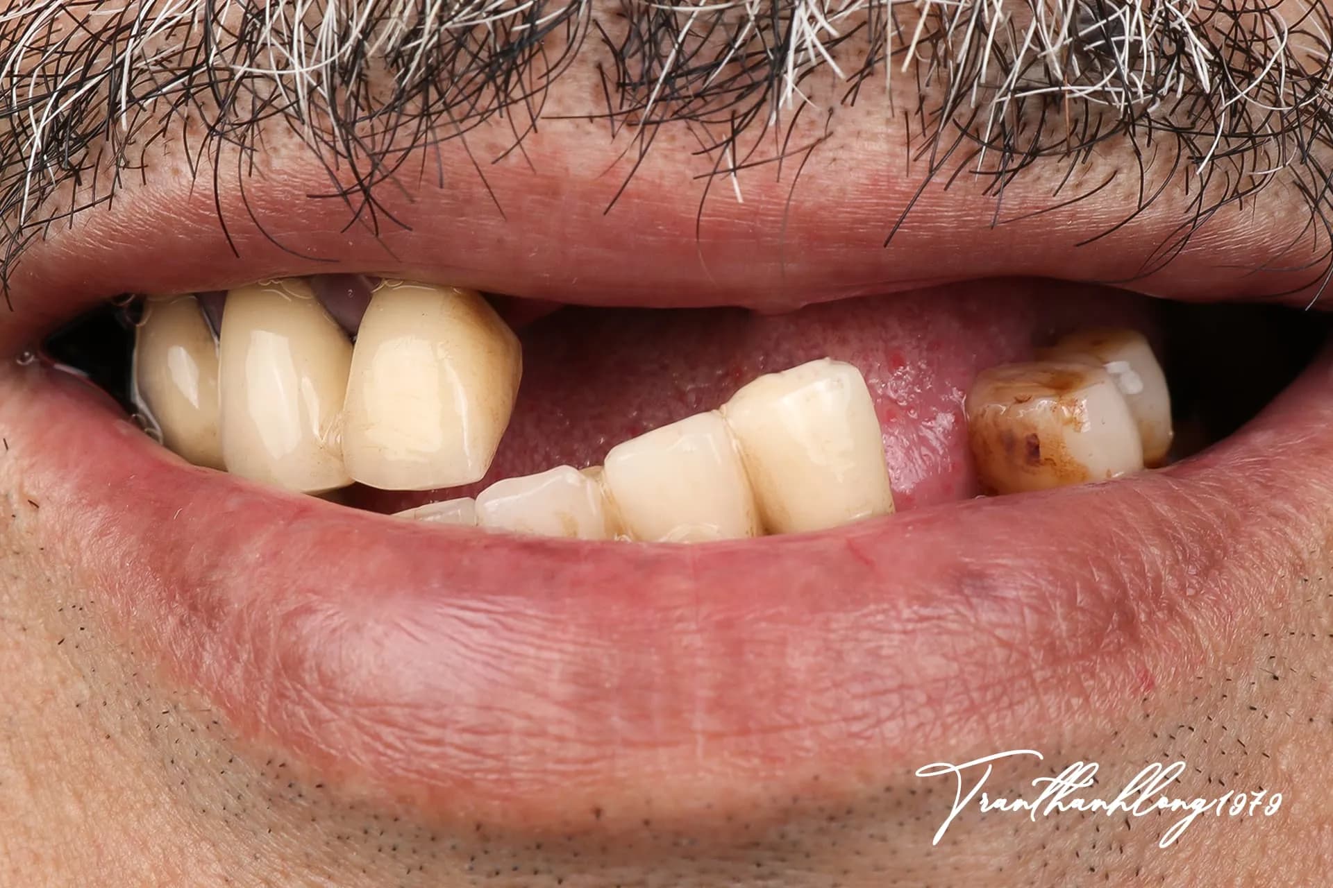 Kết quả điều trị của  007030923 - Before