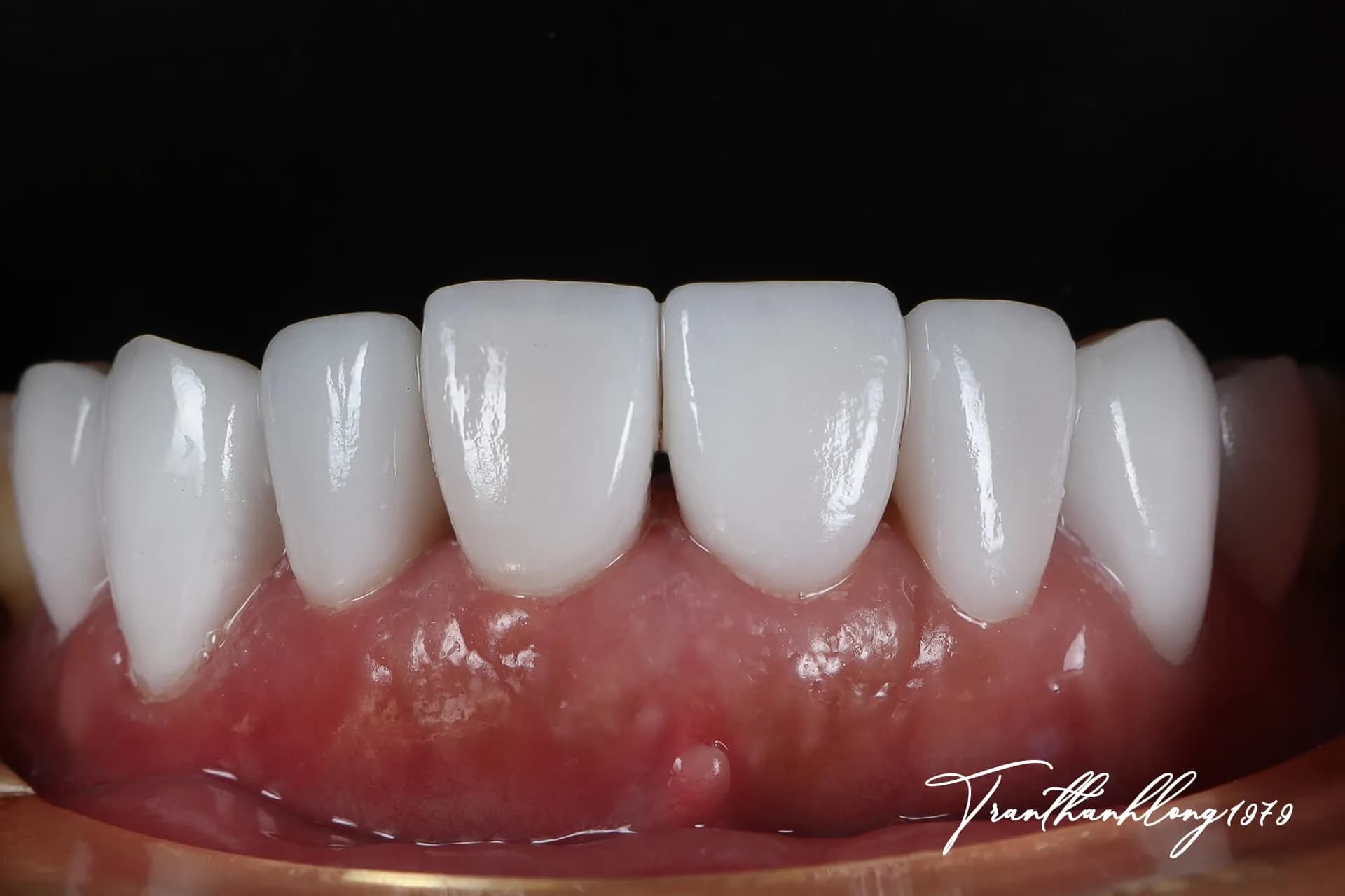 Kết quả điều trị của  004020226 - After