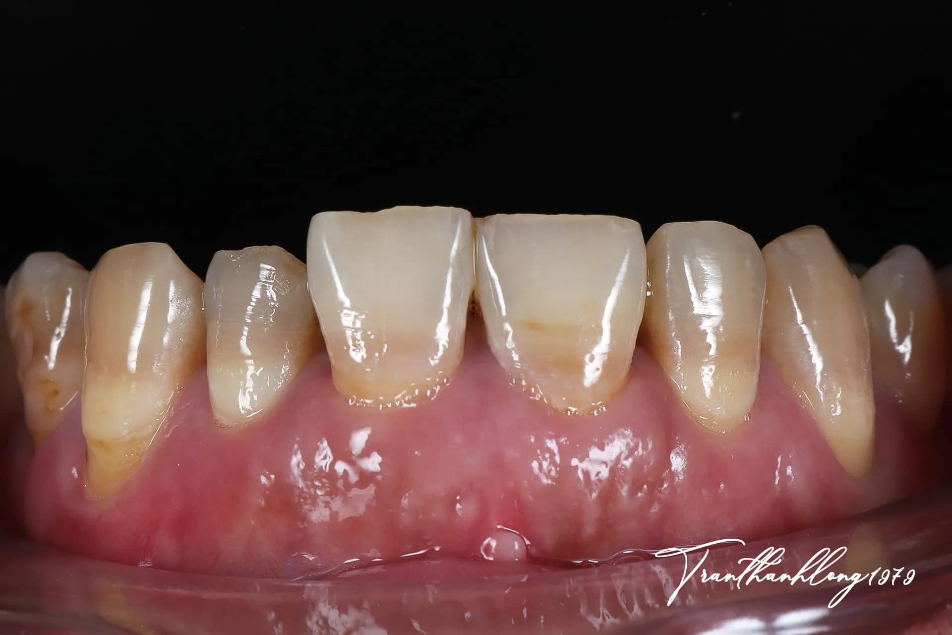 Kết quả điều trị của  004020226 - Before