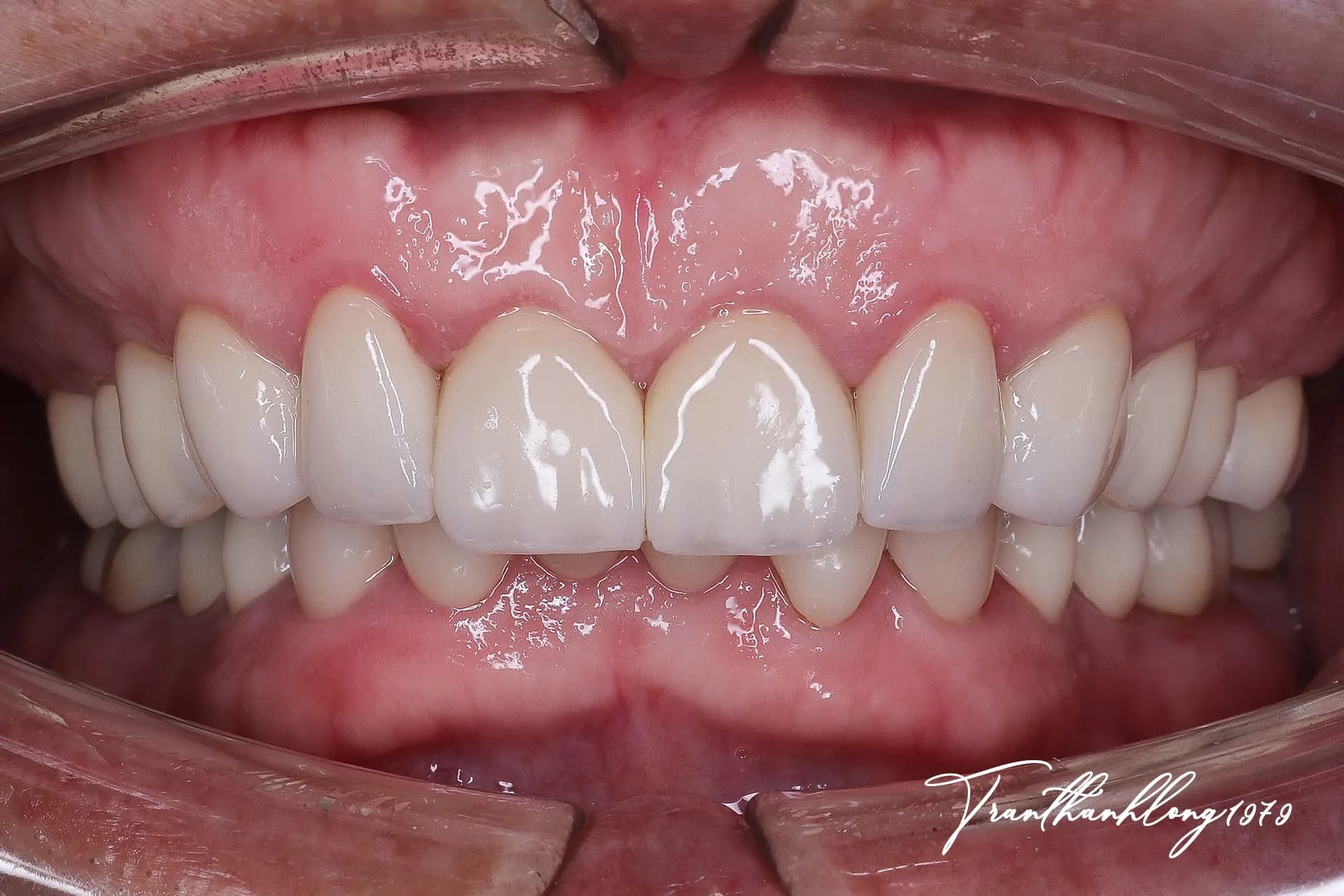 Kết quả điều trị của  002190825 - After