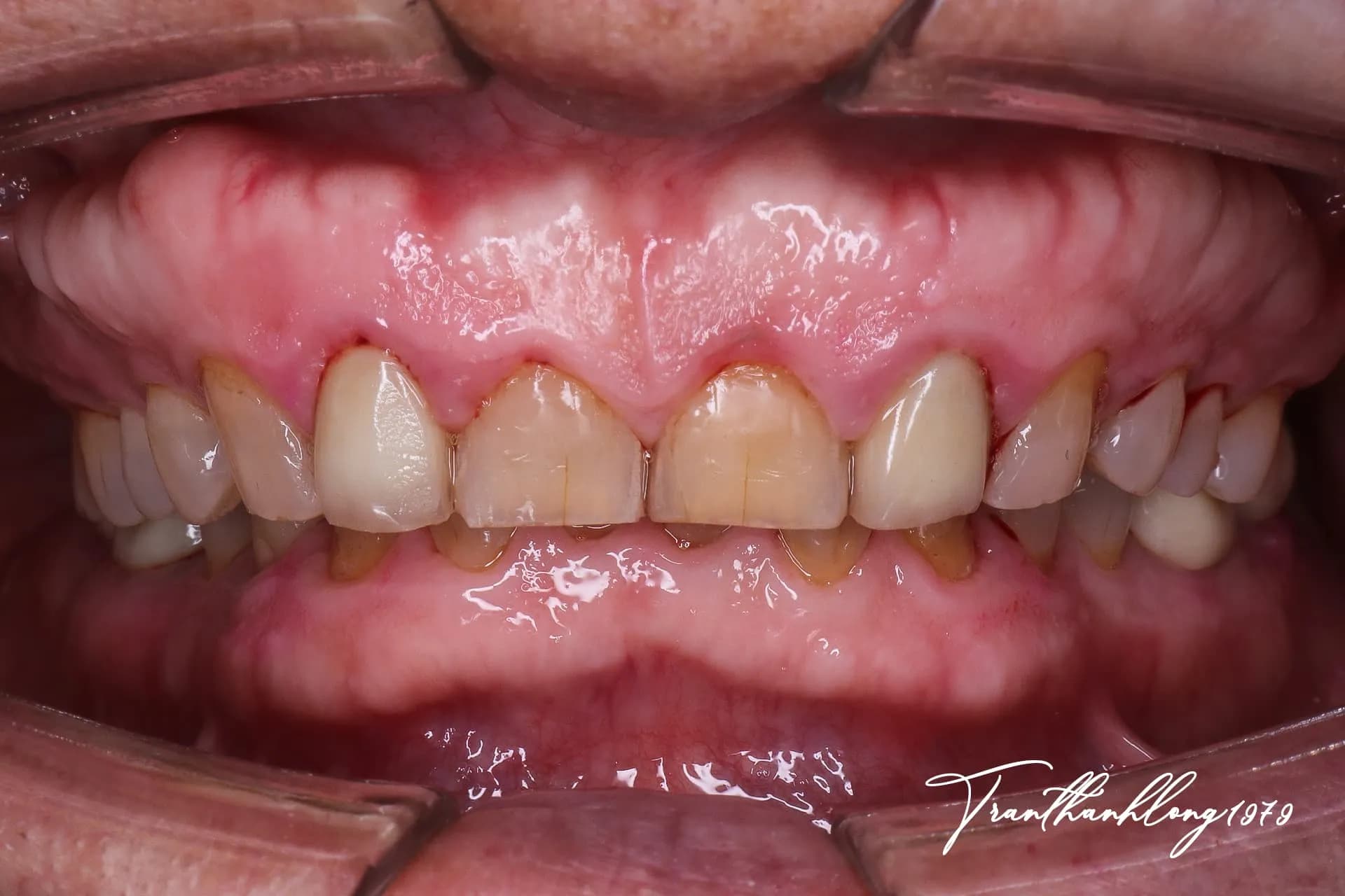 Kết quả điều trị của  002190825 - Before