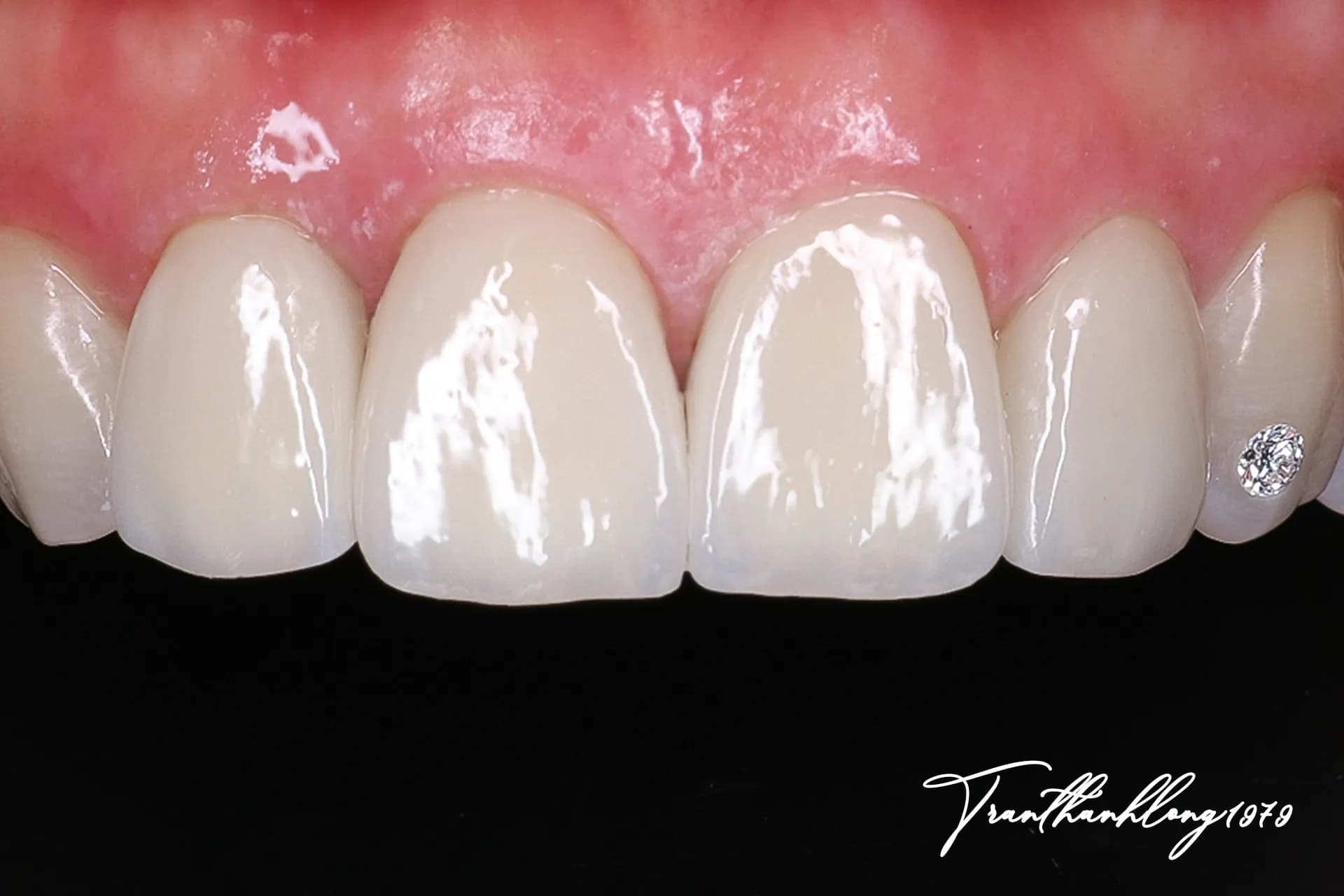 Kết quả điều trị của  003260525 - After