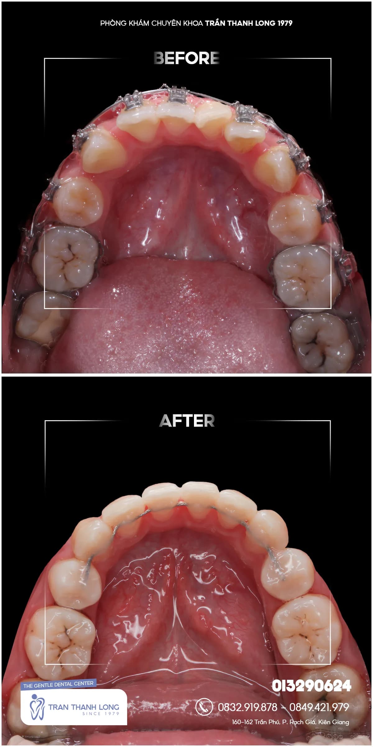 Hình ảnh quá trình điều trị 3