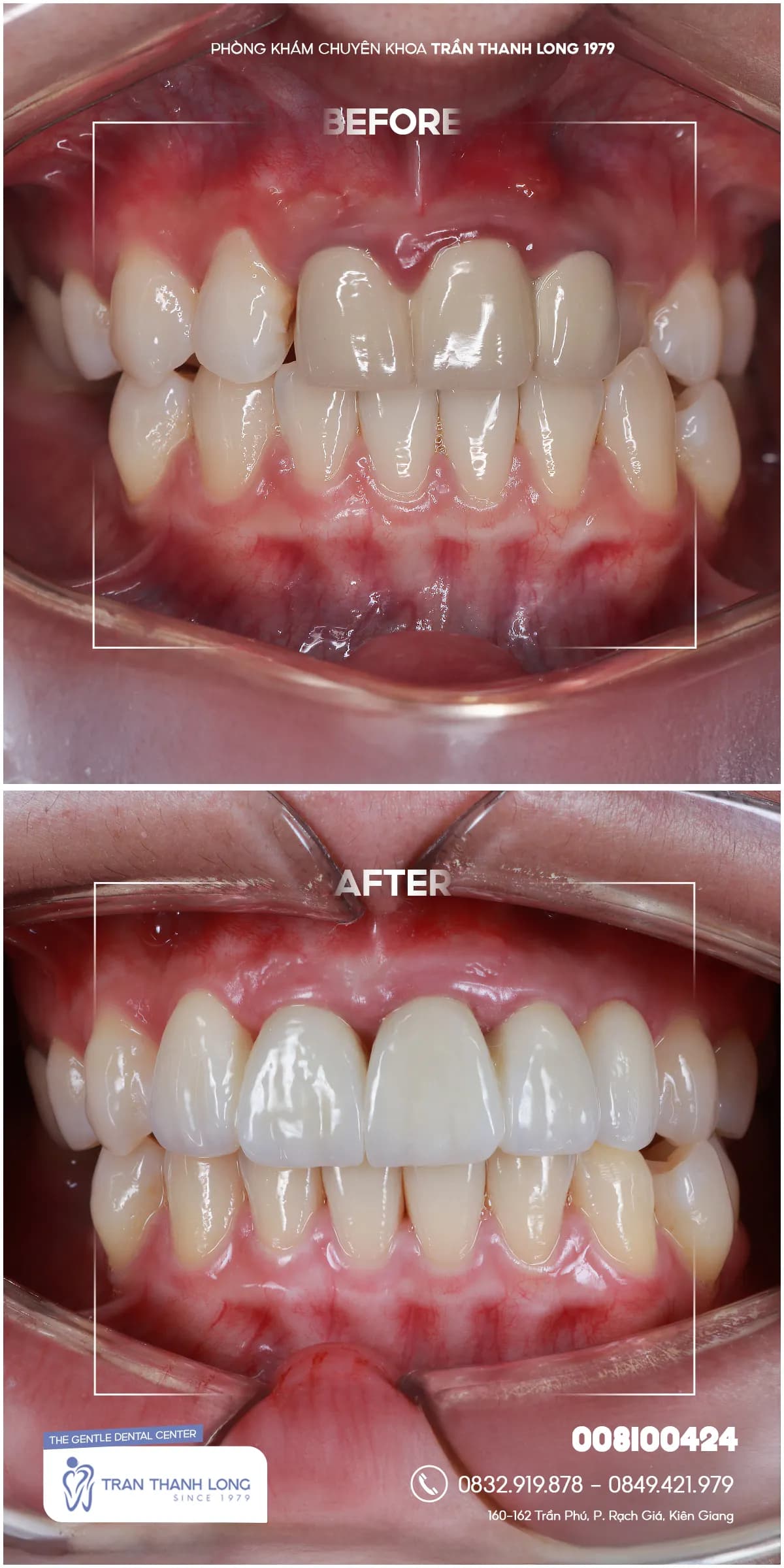 Hình ảnh quá trình điều trị 3