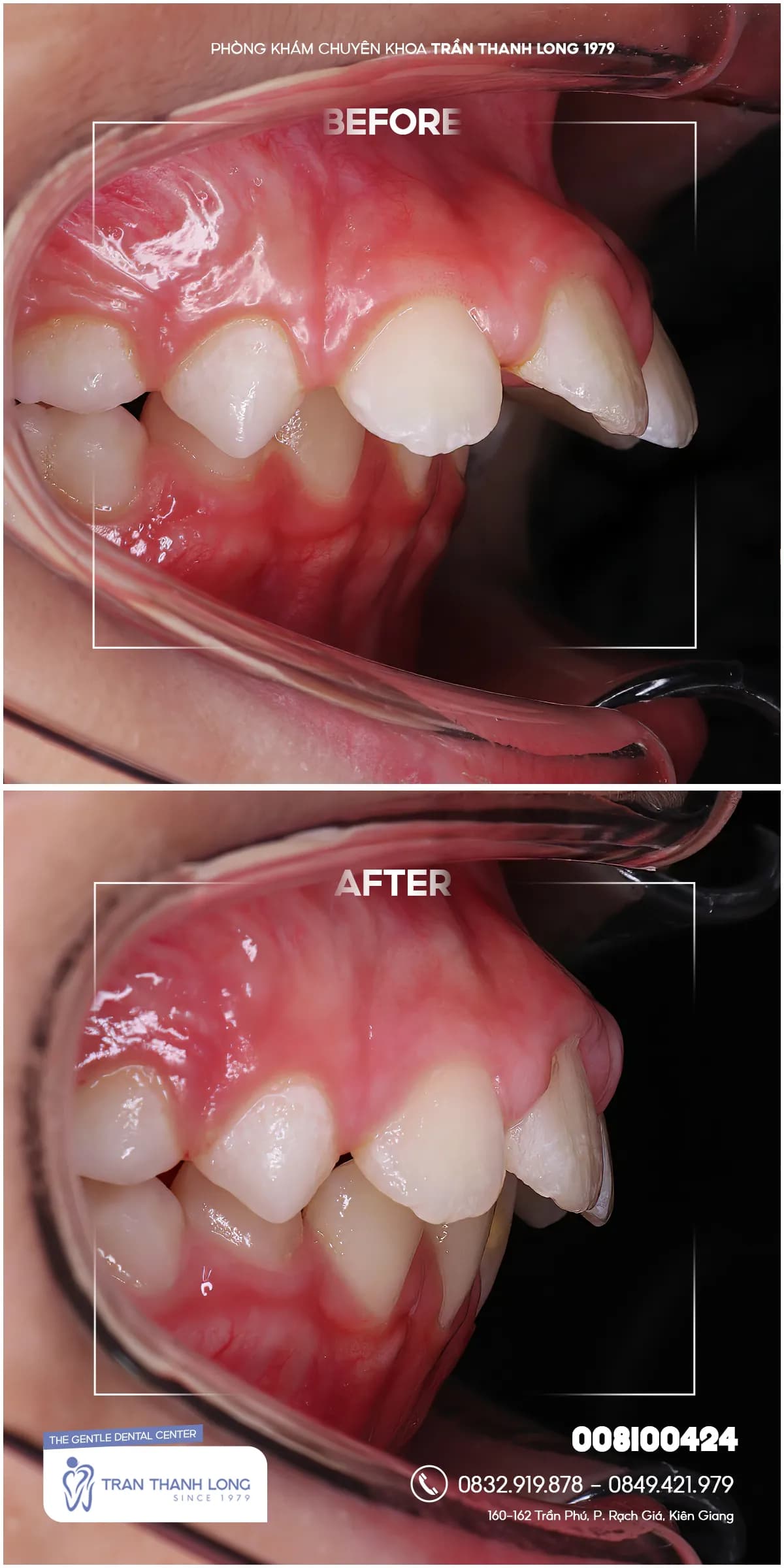 Hình ảnh quá trình điều trị 1