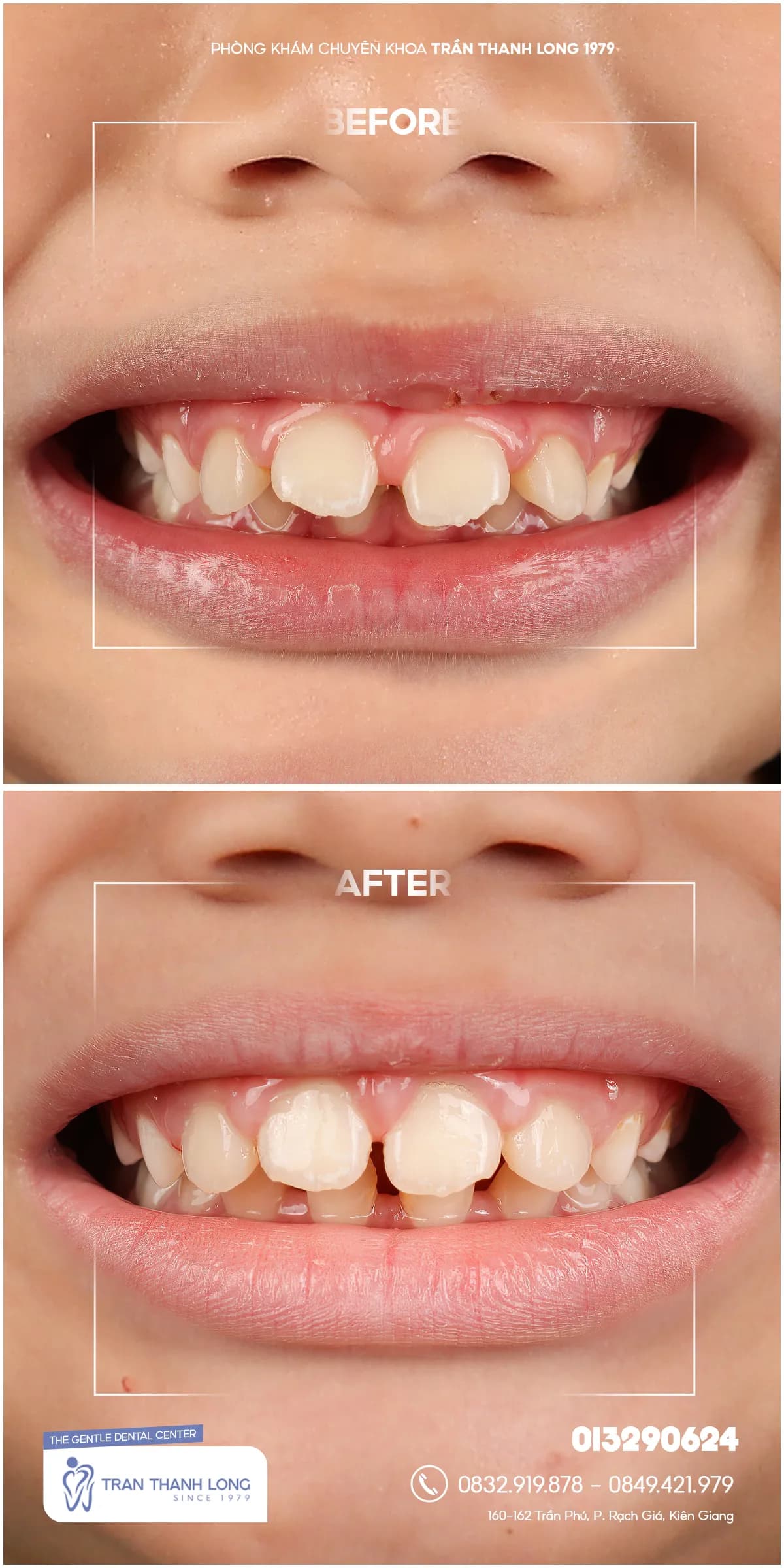 Hình ảnh quá trình điều trị 3