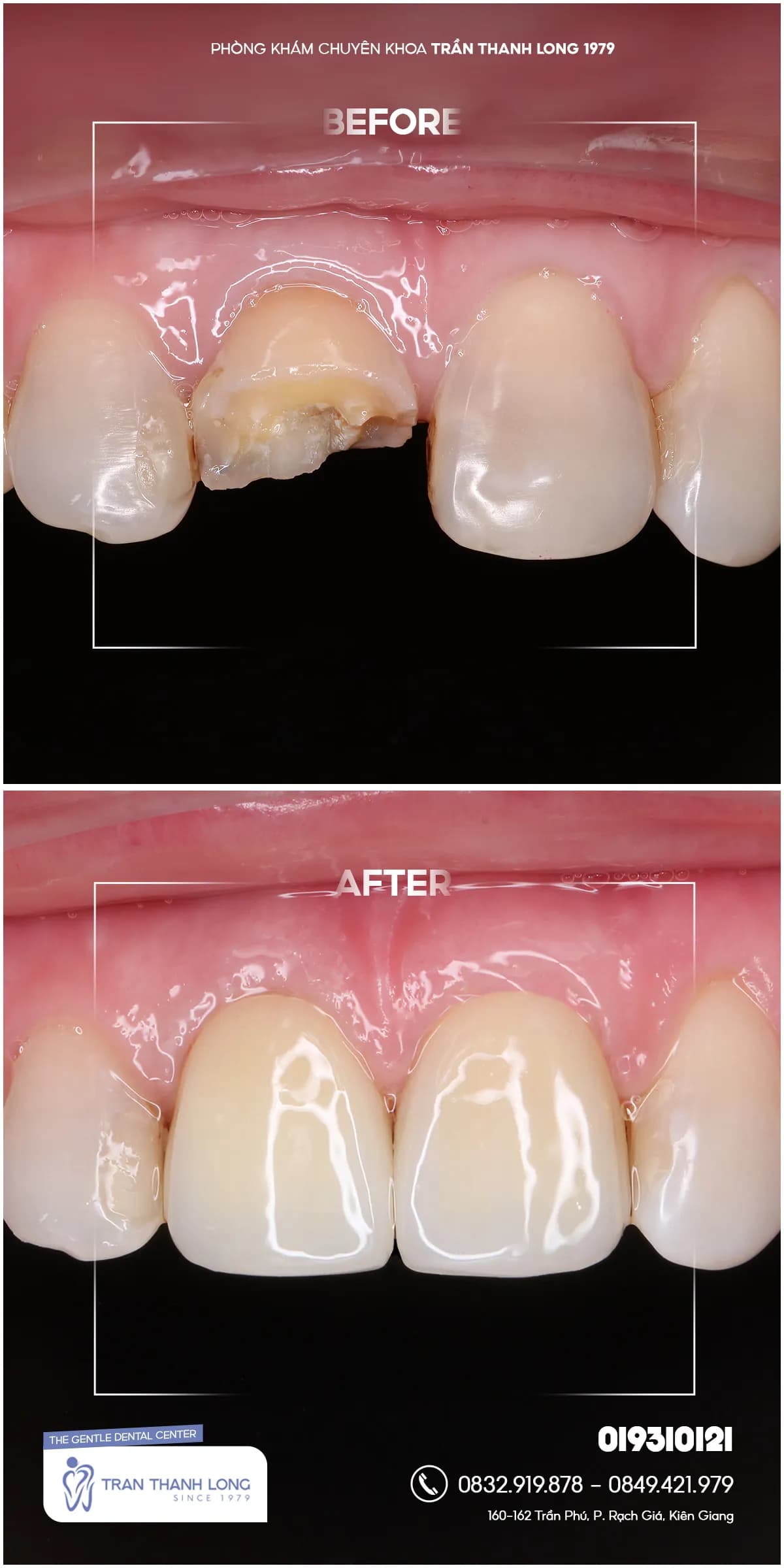 Hình ảnh quá trình điều trị 1