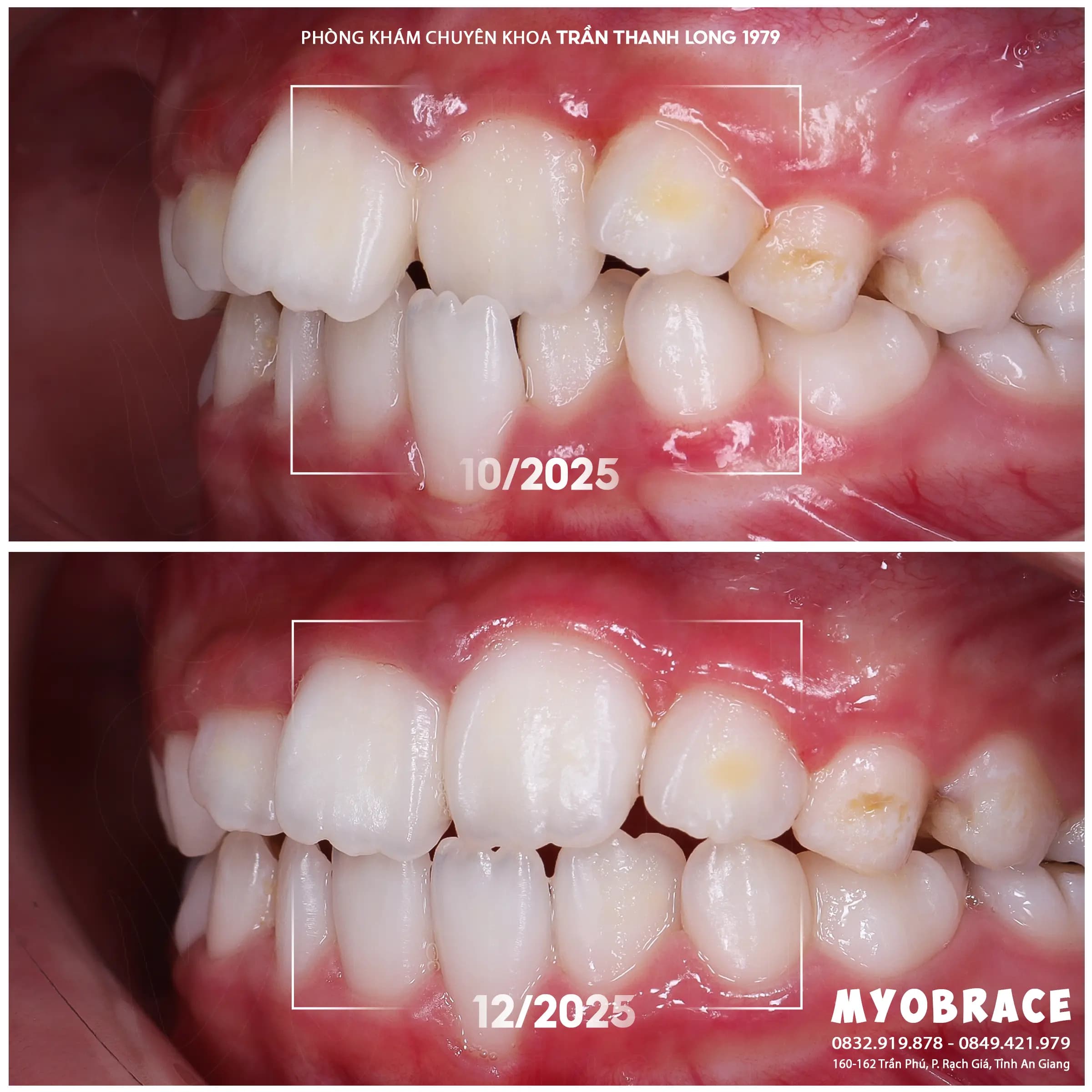 Hình ảnh quá trình điều trị 1